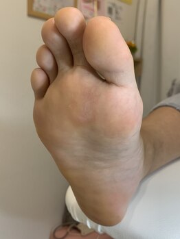 ランカ(RUNKA)/ヒールタコ１回のケアでスッキリ