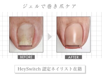 オープンセサミ 練馬/最新のジェルで行う巻き爪ケア