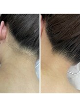 カルディエ(Cardie)/パーツ脱毛