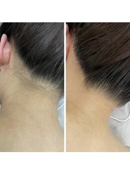 カルディエ(Cardie)/パーツ脱毛