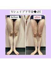 ルピナス ヒサヤ(LUPINUS hisaya)/Ｖシェイプ痩身