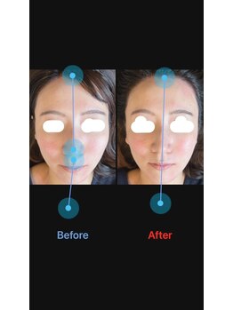 美容矯正サロン レレポノ(LELEPONO)/顔の左右差、輪郭小顔施術