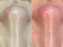 ヴィーヴ 京橋(vive)/【韓国式3D毛穴洗浄】