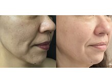 シュシュエステプリューム(Chou Chou Esthe PLUME)/