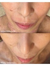 サロン ド エン(Salon de. en)/たるみケア◇ハーブピーリング