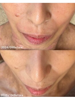 サロン ド エン(Salon de. en)/たるみケア◇ハーブピーリング