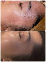 癒しサロン リバース/長崎では少ない水光ピール