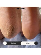 マオヌー(MAONU)/韓国式足裏角質ケア　症例写真