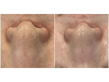 エンルーチェ プラスエイト(en;Luce+8)/ハイドロフェイシャル