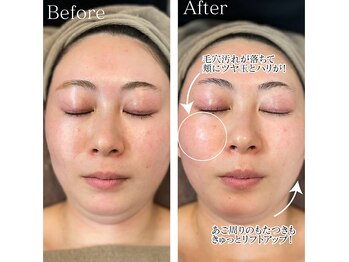 オーシャンブルー 日田店/水光アクアフェイシャル症例