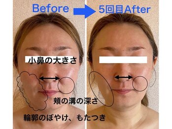 インフィニティ セルラム(INFINITY CELLULAM)/ビフォーアフター