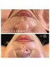 むくんでだるみ顔改善☆Wax脱毛込み【美人筋フェイシャル】