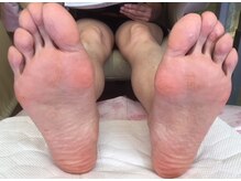 ビサンテ サロン/魚の目・鶏眼(ケイガン)のお悩み