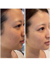 ステラ(STELLA)/光フェイシャル