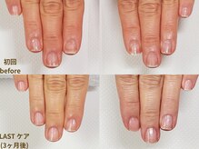 ナユネイル(na_yu.nail)/【地爪育成 症例２】