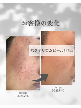 プレジール(Plaisir)/お手入れ4回・ホームケア使用