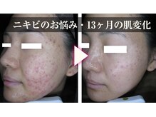 マイン イオンモール浜松市野店/ドクターリセラADS美肌活性