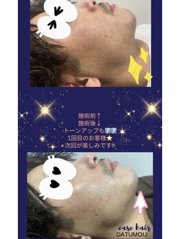 イースヘアーアンドビューティーショップ(ease hair&beauty shop)/美肌脱毛