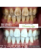 ホワイトニングサロン 札幌店/ 【ホワイトニング施術例】#札幌