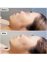 アンシャンテ(ENCHANTER)/お顔リフトアップ