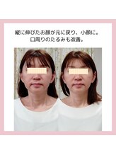 目元 口元のたるみ 眉間シワ改善専門サロン/小顔を取り戻したい方向け★