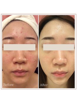 ベルタ(BELTA)/ケア前→6ヶ月後　ニキビ/肌荒れ