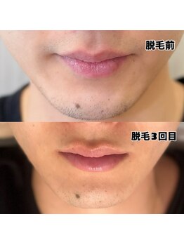 オルテンシア(Hortensia)/顔脱毛/髭脱毛