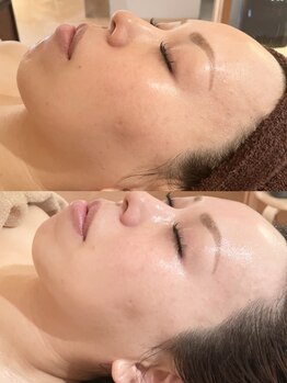 ミニョンボーテ(mignon beaute)/before/after 30代