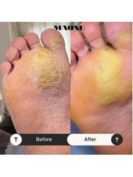 マオヌー(MAONU)/韓国式足裏角質ケア　症例写真