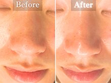 ボーンオム(Born Homme)/毛穴洗浄＋美容液導入：30代女性