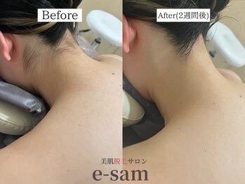 イーサム 高槻摂津富田店(e-sam)/丸ごと全身脱毛