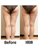 つばききよら/内ももの隙間が3回目で発生！