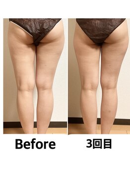 つばききよら/内ももの隙間が3回目で発生！