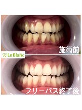 ルブラン 奈良店(Le Blanc)/矯正前のwhitening！！