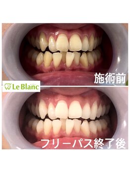 ルブラン 奈良店(Le Blanc)/矯正前のwhitening！！
