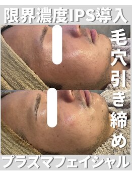 アディス 心斎橋(ADISE)/限界濃度IPS導入プラズマ美肌