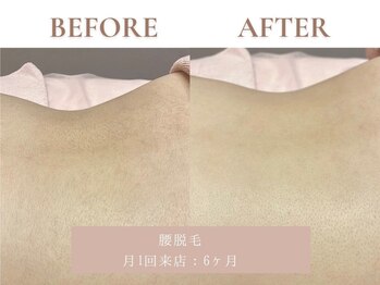 サエラ(SAERA)/腰脱毛【6回】