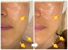 サロン ド ジョワ(salon de joie)/リフトアップでほうれい線改善