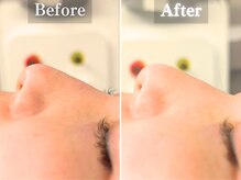 ボーンオム(Born Homme)/毛穴洗浄＋美容液導入：10代女性