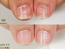 ナユネイル(na_yu.nail)/【地爪育成 症例 ２】