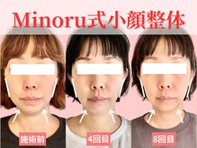 フレキシボディ(FlexiBody)/小顔施術ビフォーアフター #13