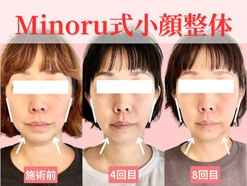 フレキシボディ(FlexiBody)/小顔施術ビフォーアフター #13