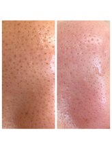 エール(Ailes)/毛穴ケア 毛穴洗浄