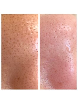 エール(Ailes)/毛穴ケア 毛穴洗浄