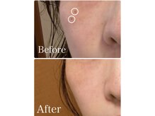 アブニールブリヨン/シミケアBefore After[シミケア]