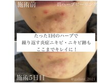 ギャラント(GALLANT)の雰囲気（【敏感肌OK】繰り返す肌荒れの根本肌質改善に碧ハーブピーリング）