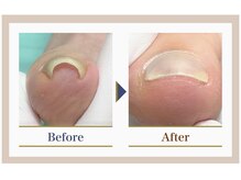 巻き爪補正店 錦糸町店/【巻き爪補正】