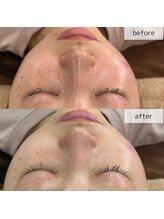 ヴィーナス(Venus)/エステ版ポテンツァ　1回