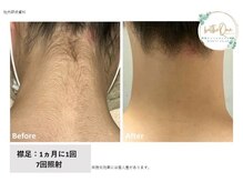 ベルティーク(beltheQue)の雰囲気（最強脱毛器★7回うなじ脱毛BeforeAfter）