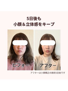 プレシャス(PRECIOUS)/小顔矯正5日後のアフター